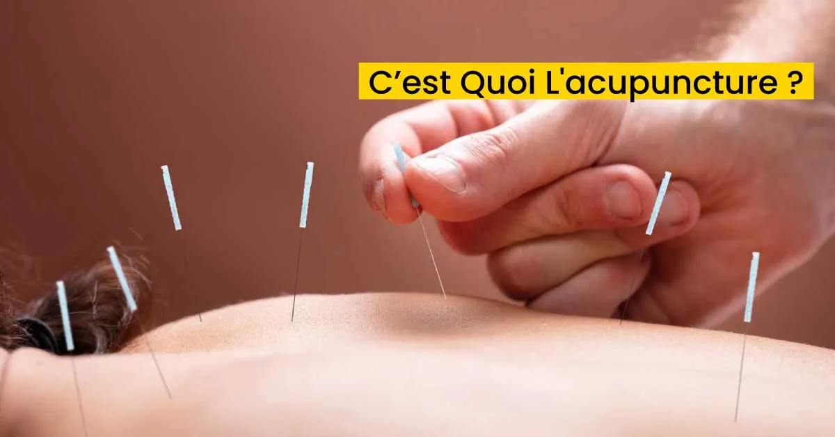 C’est Quoi L'acupuncture
